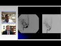 Flow Diversion for Cerebral Aneurysms: A Discussion of Controversies