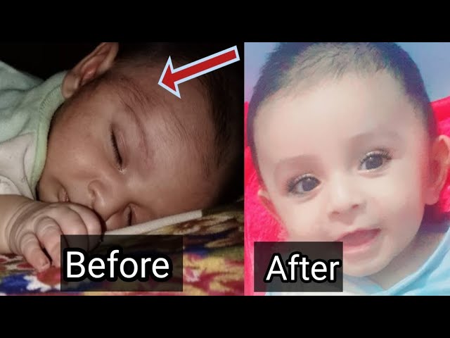 How to remove unwanted hair from Baby's skin | Newborn forhead hair removal  Permanently - YouTube