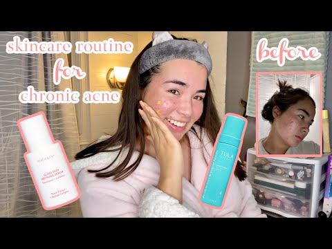 Skincare routine for chronic acne ft. Tula, Peach & Lily