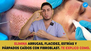 Levantamiento de párpados SIN CIRUGIA / Fibroblast | DOCTOR LEMUS