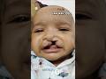 5 Years Later: Incredible Transformation After Cleft Lip &amp; Palate Surgery