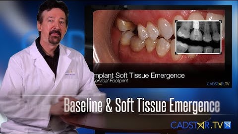 CEREC Software Design Implant Baseline Footprint Principles