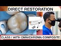 Step by Step Class I Omnichroma Composite | General Dentist Griya RR