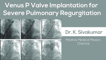 Venus P Valve Implantation for Severe Pulmonary Regurgitation