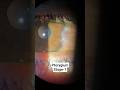 Pterygium #eyes #eyehospital #opthalmology #optometry #eyecare