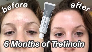 6 Month Tretinoin/RetinA Update: Before & After + My Current Skincare Routine!