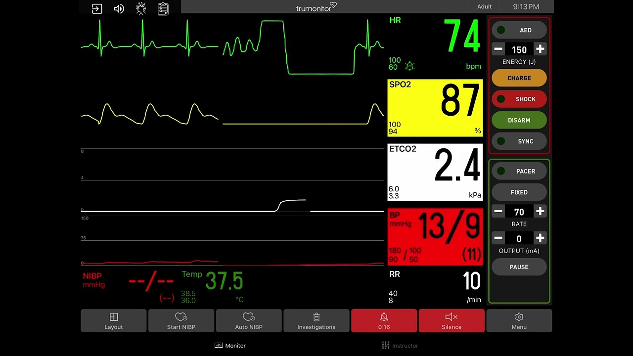 Ventricular Fibrillation with Defibrillation