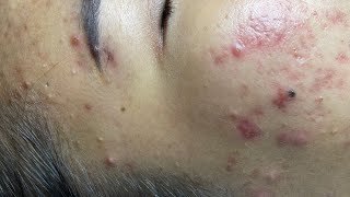 Relaxing acne treatment with Linh My Dang #372 P2 (Linh My Dang)