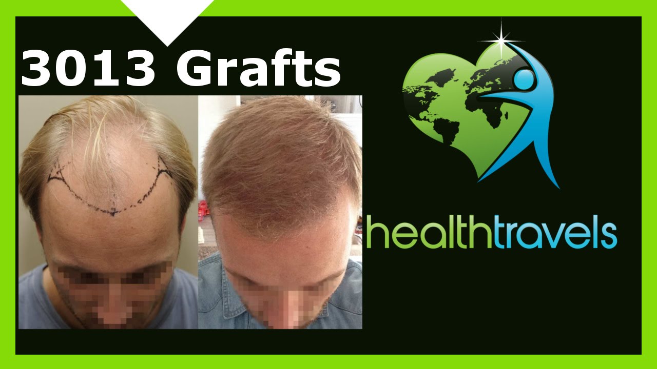 Health Travels - 3013 Grafts Before and After Pictures - FUE hair transplant Istanbul - Dr. Demirsoy