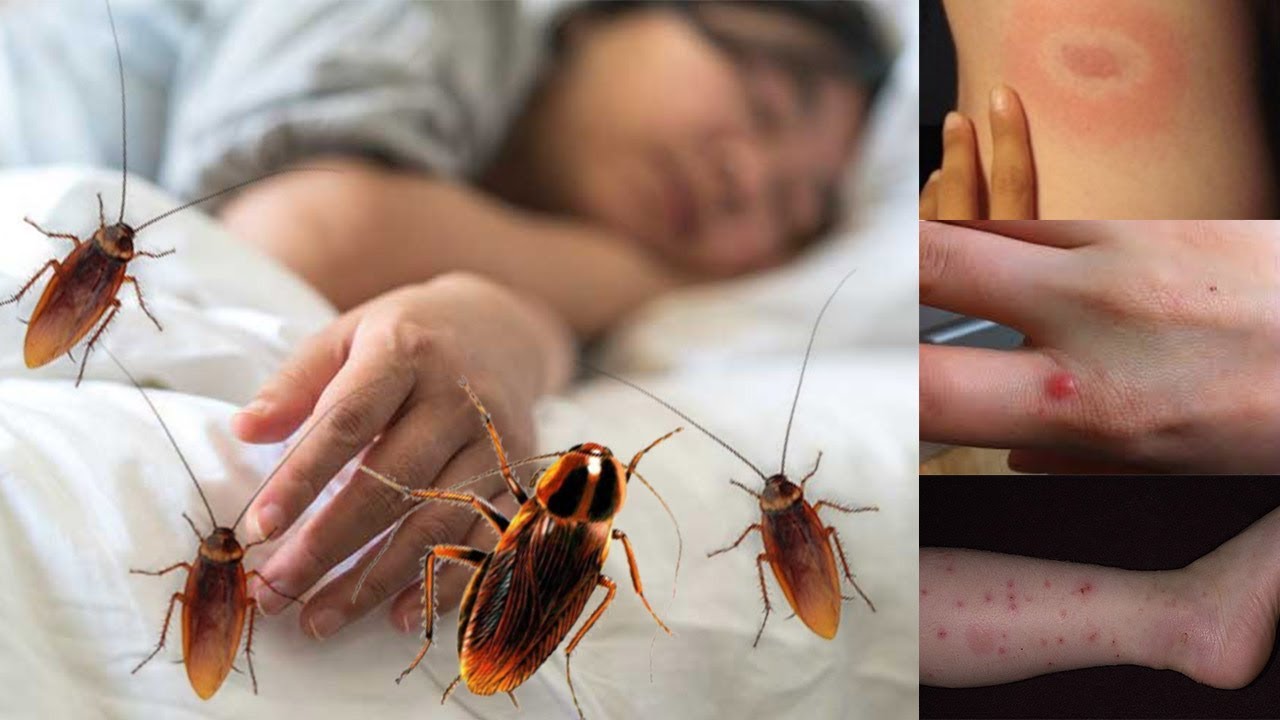 How Do You Know If A Roach Bite You?