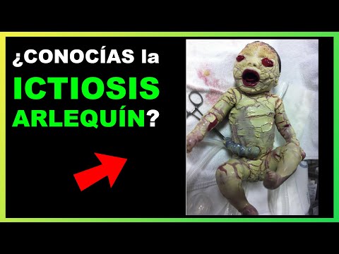 Vídeo: Ictiosis Cutánea (congénita, Vulgar, Arlequín): ¿que Es? Síntomas Y Tratamiento
