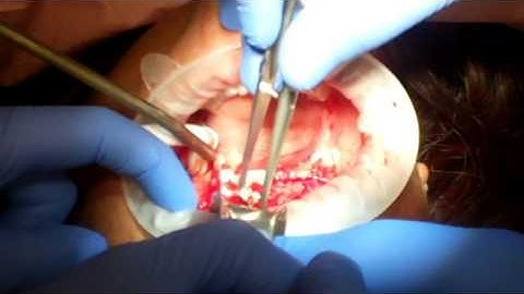Ridge Augmentation using A-PRF, I-PRF