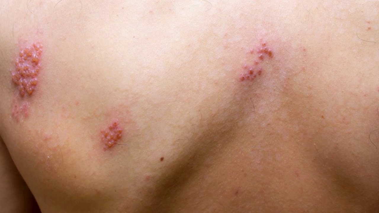 Can itchy skin be a sign of liver problems YouTube