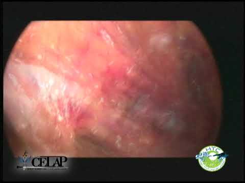 HEMICOLECTOMIA IZQUIERDA POR LAPAROSCOPIA camera iphone 8 plus apk