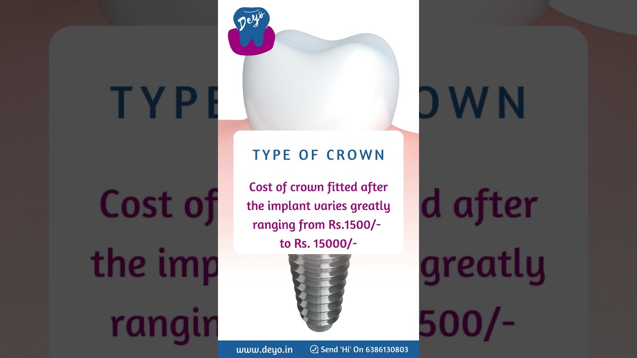 Cost Of Dental Implant