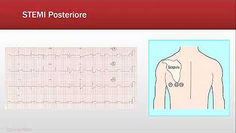 Cosa significa infarto non Q?