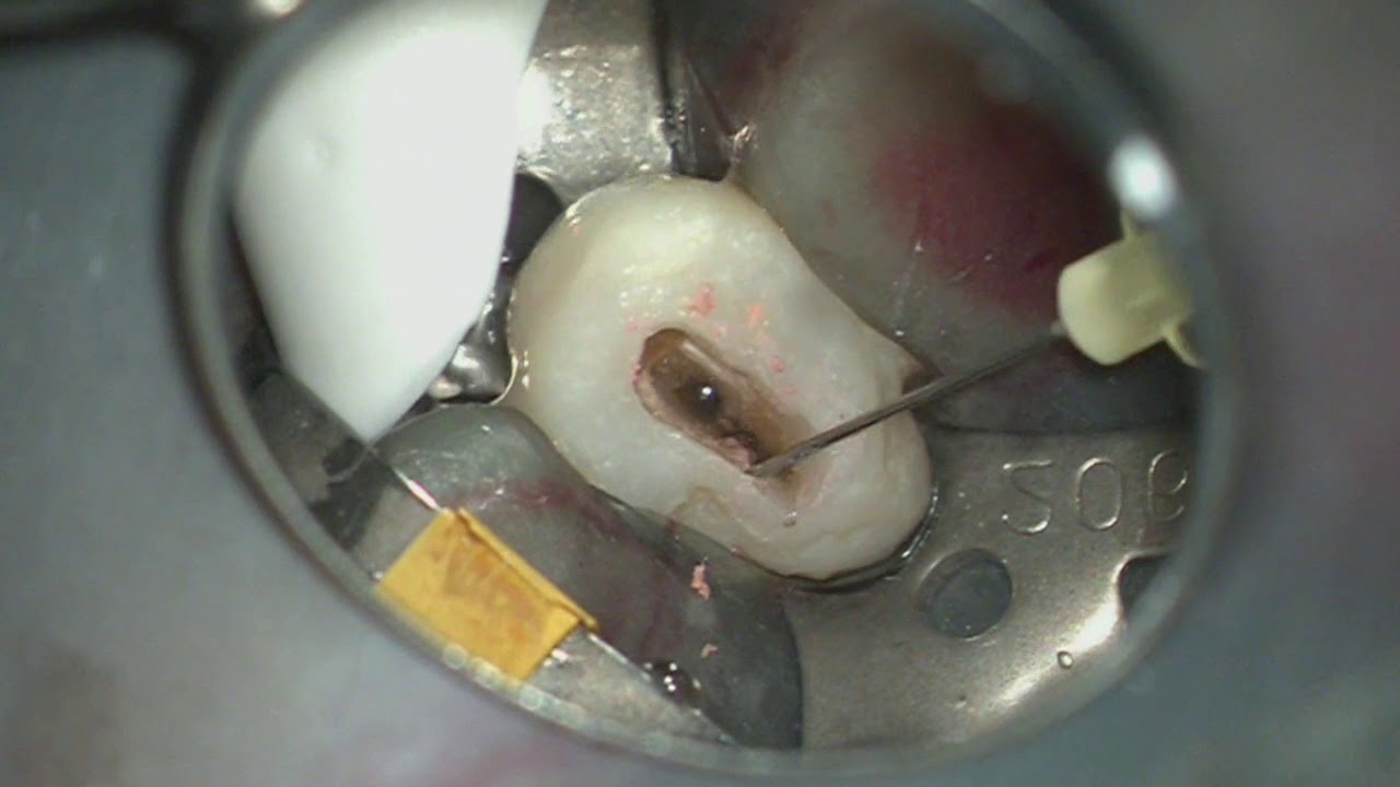 Endodontic Retreatment with the XP3D Instrumentation YouTube
