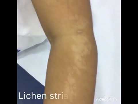 ليس كل بقعه بيضاء بهاق