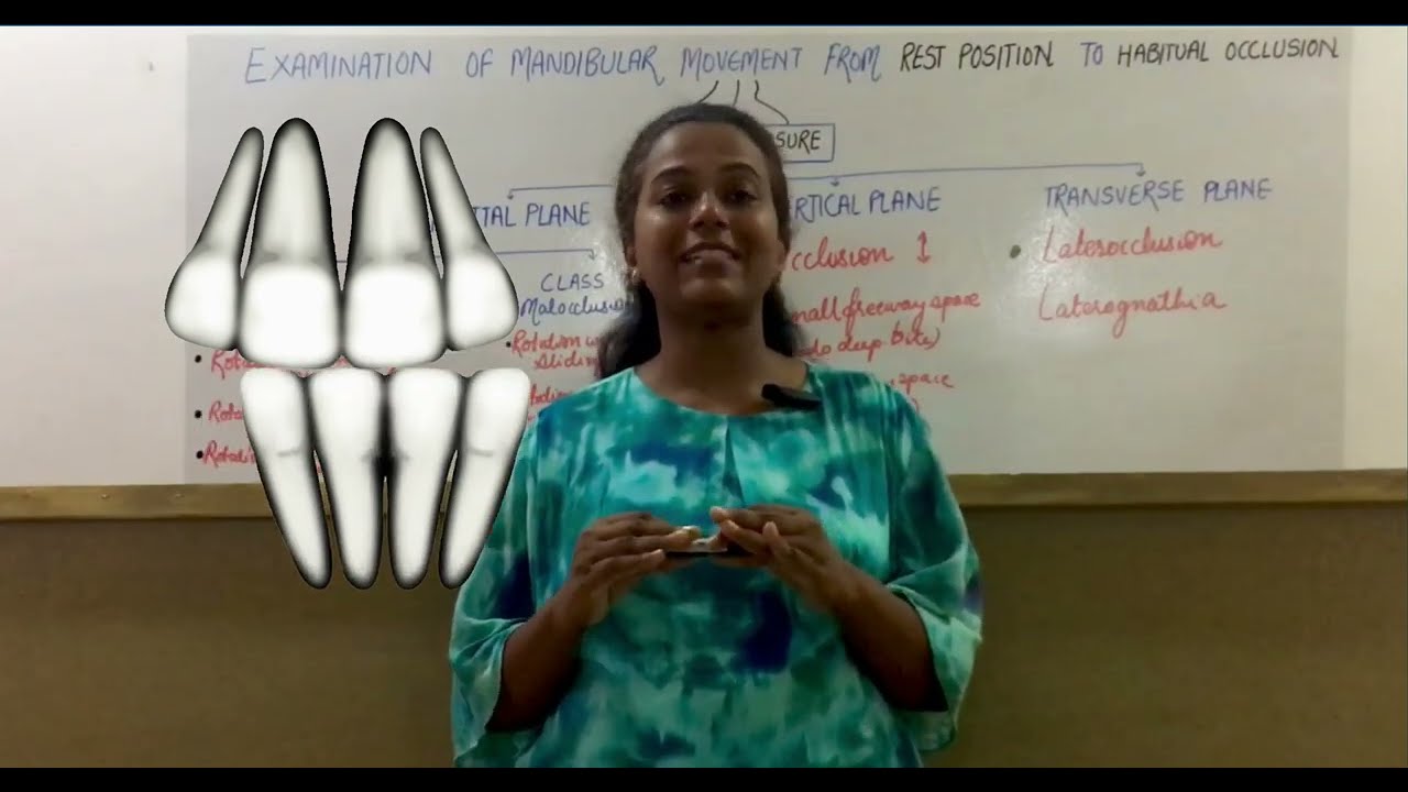 Mandibular path of closure l Rest position to habitual occlusion l Functional Analysis Class 2