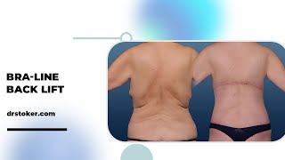 Defying Gravity Unbelievable Bra-Line Back Lift Results