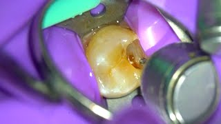 Live: Root Canal Procedure (29) Under The Microscope W/ Specialist