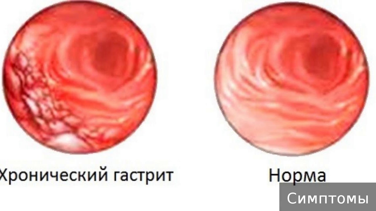 Слизистая атрофична. Поверхностный и атрофический гастрит. Эритематозный гастрит. Геморрагический гастрит эндоскопия.