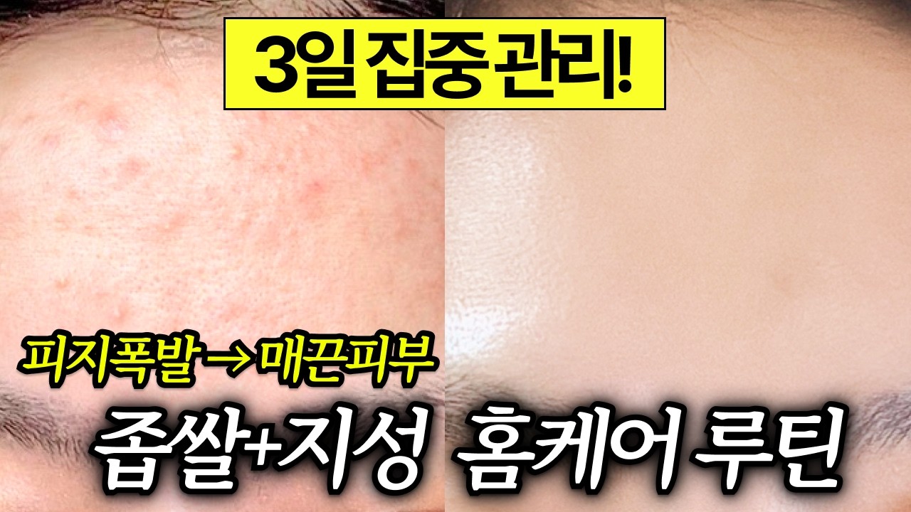 딱 3일만 해보세요!ㅣ좁쌀 , 수부지 피부가 여름에 피지 없애는 루틴