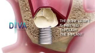 DIVA - Low trauma sinus lift implant (Full video)