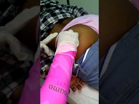 Inyeccion intramuscular en el gluteo