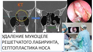 УДАЛЕНИЕ МУКОЦЕЛЕ РЕШЕТЧАТОГО ЛАБИРИНТА И СЕПТОПЛАСТИКА НОСА лор-хирург к.м.н. Фуки Е. М.