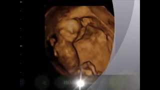 12 weeks 3 days. Baby Boy. Gender Determination Reveal Party. 3D\/4D Ultrasound