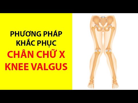 Khắc phục chân chữ X (Valgus Knee)|Nguyên nhân và giải pháp|Yoga Home| Hà Liên - YouTube Khắc Phục Chân Chữ X (Valgus Knee)|Nguyên Nhân Và Giải Pháp|Yoga Home| Hà Liên - Youtube