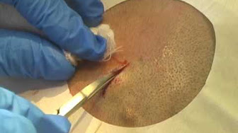 Erupting Boils - YouTube