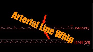 Arterial line whip