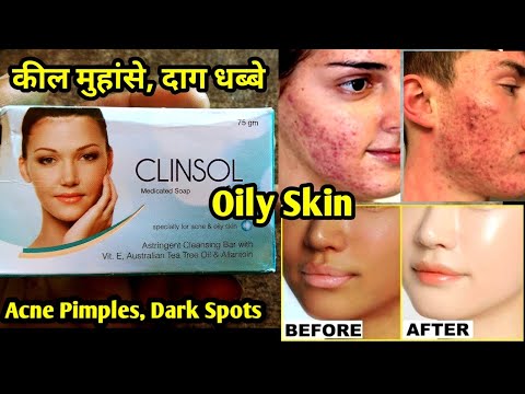 Clinsol soap | Clinsol Gel | Ancestar Saop | Acne Aid Saop | Acne Pimple Soap | Dermadew Acne Saop
