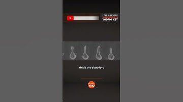 Atrophic Ridge Case I Full Mouth Rehabilitation Solution #ThinRidge #Fixedimplants #AtrophicRidge