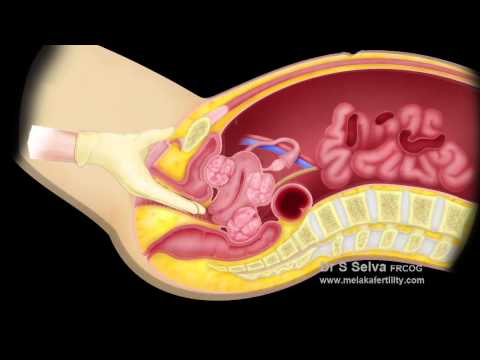 Video: Fibroid Pedunculated: Gejala, Diagnosis Dan Pengobatan