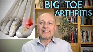 Big Toe Arthritis : Hallux Rigidus / Limitus  A 'StepbyStep' Guide