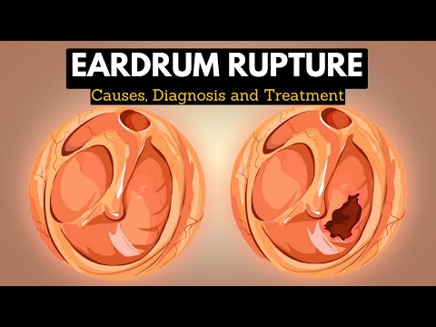 The Science Behind Eardrum Rupture: Explained In Simple Terms