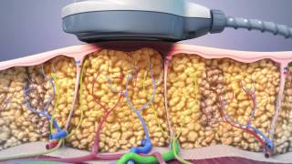 UltraShape Mechanism of Action Animation | Cosmetic Plastic Surgeon Dr. Sundin