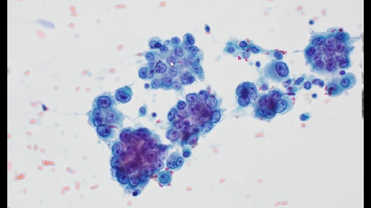 primary peritoneal carcinoma vs mesothelioma