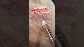 Redness treatment | Rosacea treatment | growth factors for skin rejuvenation | PRP for Rosacea