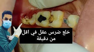 خلع ضرس عقل سفلي في اقل من دقيقة|| extraction of lower wissdom teeth