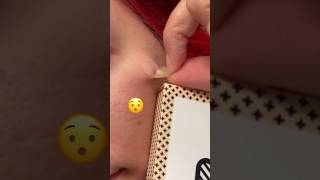 😯 LOVE a good pimple patch reveal! #acneproneskin #pimplepatches #pimplessolution
