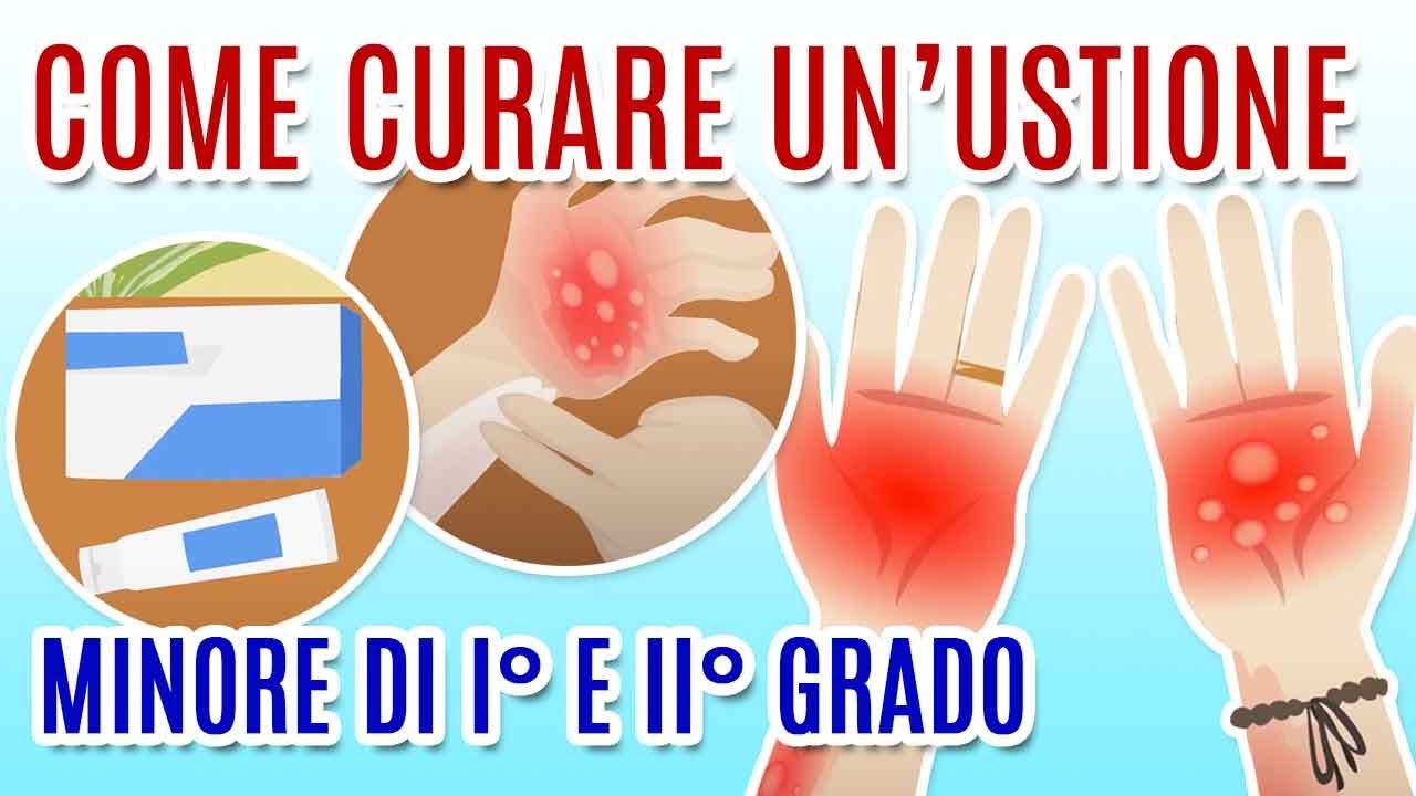 COME CURARE LE USTIONI? YouTube COME CURARE LE USTIONI? YouTube