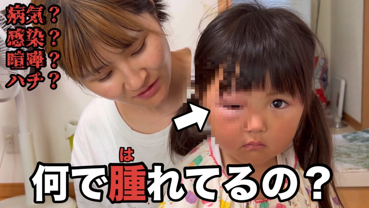 【目が腫れてる】三女ユノの目がパンパンに腫れている！一体なぜ腫れている？