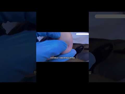 Having a foot repair is really nerve wracking#foot  #pedicure  #automobile #vlog