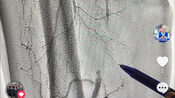 A challenging case of Trans-brachial PTA on SFA, CTO- chronic occlusion. Step by step!