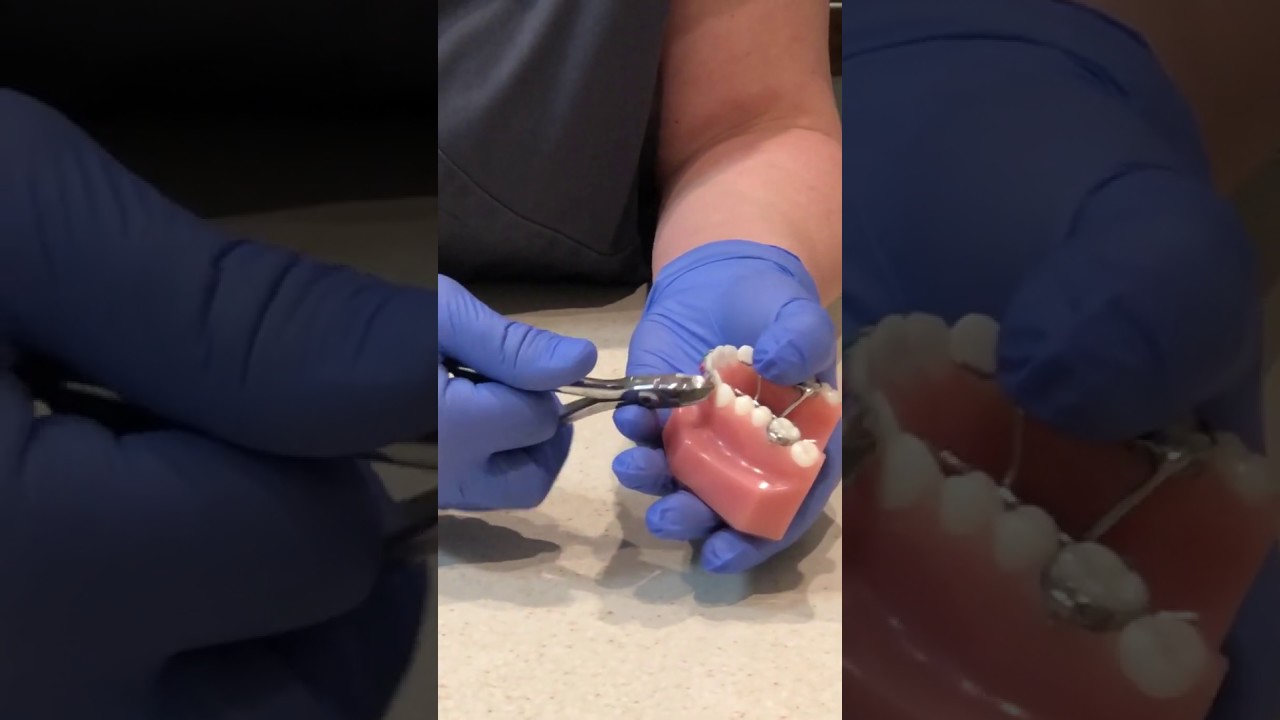 Clipping a Orthodontic wire in case of emergency