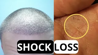 SHOCK LOSS Trasplante de PELO / ¿Cuándo empieza? ¿Lo voy a sufrir? ¿Se puede parar?